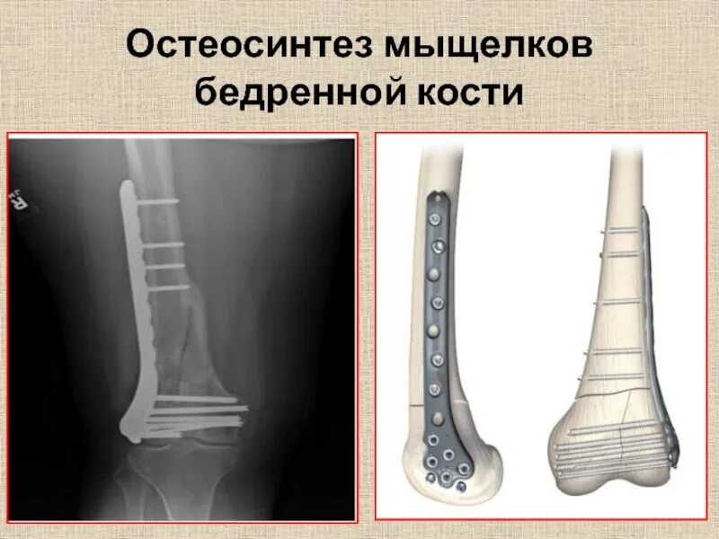 Перелом мыщелка бедренной кости. ИМПЛАСТ остеосинтеза бедренной кости. Перелом мыщелка большеберцовой кости остеосинтез рентген. Остеосинтез мыщелка