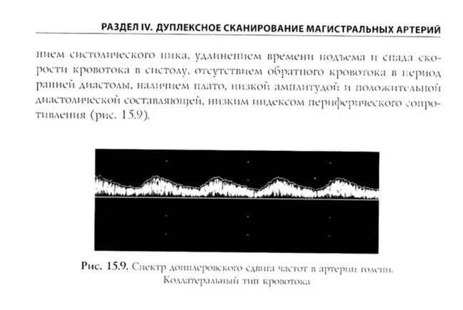 Тип кровотока 1 типа. Магистрально измененный тип кровотока на узи. магистральный и коллатеральный тип кровотока. спектр магистрального типа кровотока.