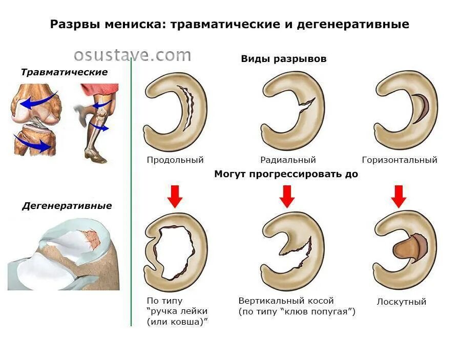 Изменение внутреннего мениска. Степени тяжести повреждения мениска. Повреждение медиального мениска 3 степени. Разрыв заднего рога медиального мениска 2 стадии. Разрывы менисков коленного сустава классификация.