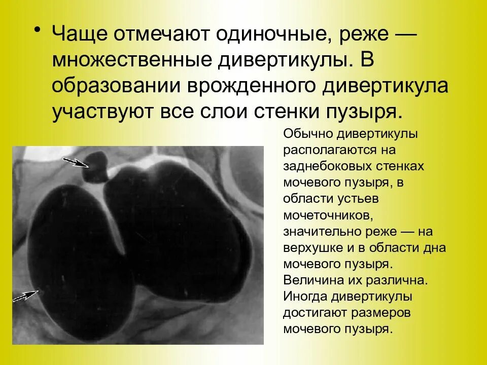 Дивертикул мочевого пузыря что это такое. Дивертикул мочевого пузыря рентген. псевдодивертикулез стенок мочевого пузыря. дивертикул мочевого пузыря рентген описание. цистография дивертикул мочевого пузыря.