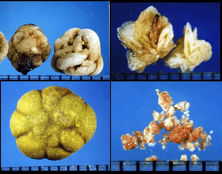 Уратные камни. Калькулезный пиелонефрит макропрепарат. Мочекаменная болезнь цистиновые камни. Струвиты камни в мочевом пузыре.