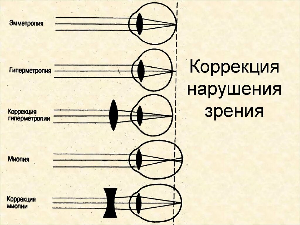 Нарушения функций зрения. Нарушение зрения. Тяжелые нарушения зрения. Основные нарушения зрения. Нарушение зрения и их исправление.