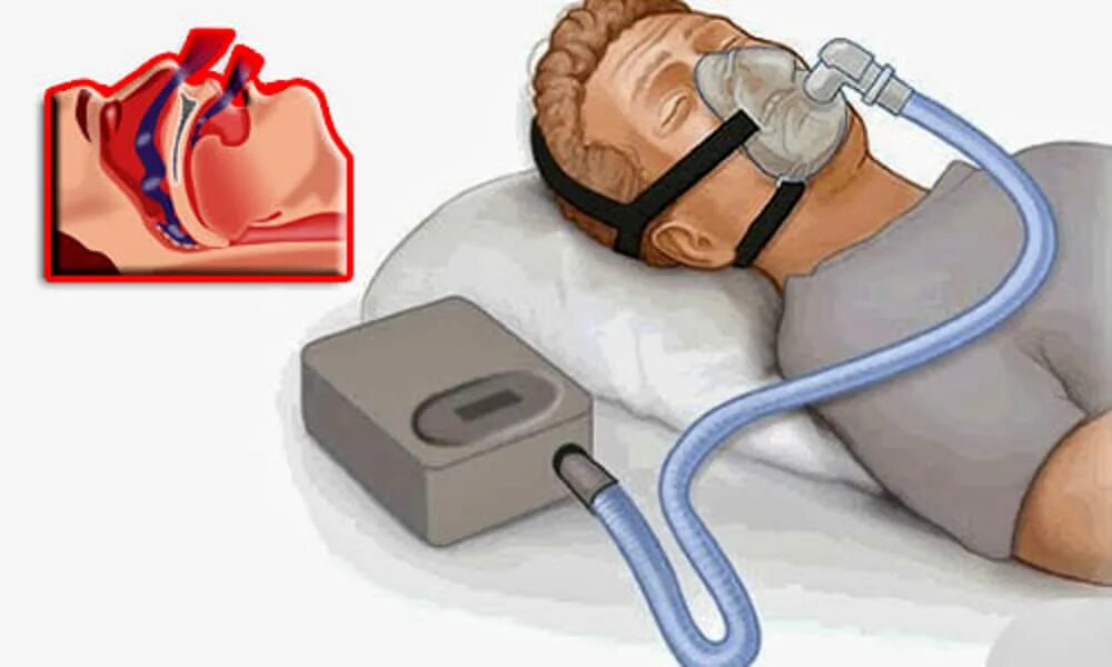 Апноэ сипап. Противопоказания к cpap. медицинский сон. cpap и bipap отличие. сипап картинки.