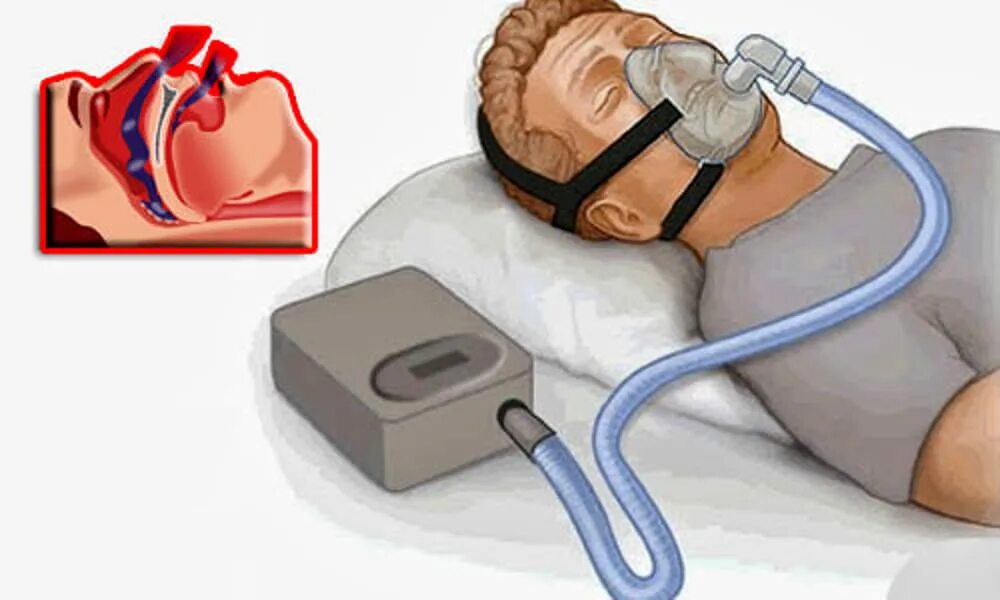 Апноэ сна сипап терапия. Аппарат сипап ИВЛ. Сипап аппарат для апноэ сна. Синдром обструктивного апноэ сна сипап терапия. Сонная терапия доктора сандера