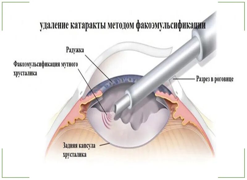 Факоэмульсификация катаракты эндотелиальные клетки. Катаракта факоэмульсификация. Операция при катаракте (факоэмульсификация). Методы удаления катаракты. Удаление катаракты clinicaspectr ru