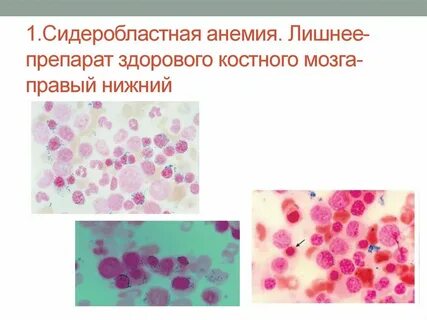 Сидеробластная анемия
