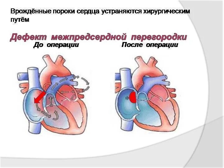 Порок сердца дмпп. Врожденные пороки дефект межпредсердной перегородки. дефект межпредсердной перегородки клинические рекомендации. впс-дмпп- дефект межпредсердной перегородки. пороки развития сердца схема.