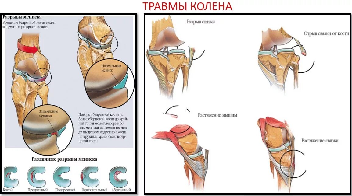 Боли коленного сустава симптомы. Разрыв связок коленного сустава презентация. Травма связок, мениска коленного сустава. Причины повреждения травм коленного сустава. Крестообразные связки коленного сустава разрыв 1 степени.