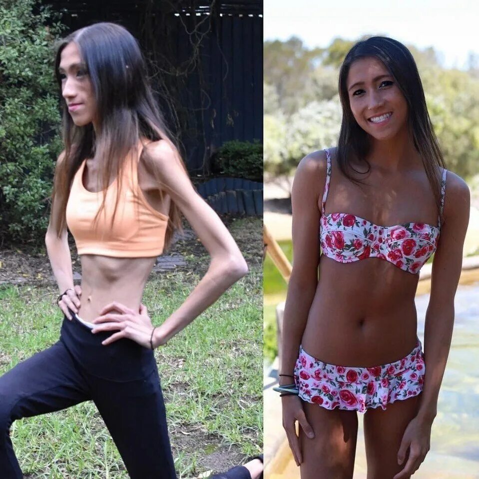 Жизнь худых. Гелиос-44 фото. Бриттани робинсон анорексия. Хайди гюнтер анорексия. Жизнь худых.