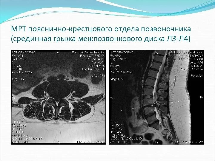 Мрт пояснично-крестцового отдела позвоночника. Мрт крестцового отдела позвоночника. Мрт поясничного отдела позвоночника. Мрт крестцово поясничного.