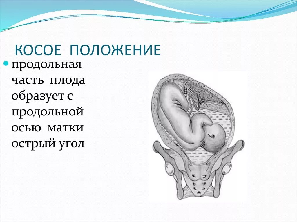 Головное косое положение плода. Продольное косое положение плода. Продольное поперечное косое положение плода. Головное предлежание косое положение плода. Самопроизвольные роды до 34 недель