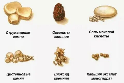 Вышел камень при мочеиспускании