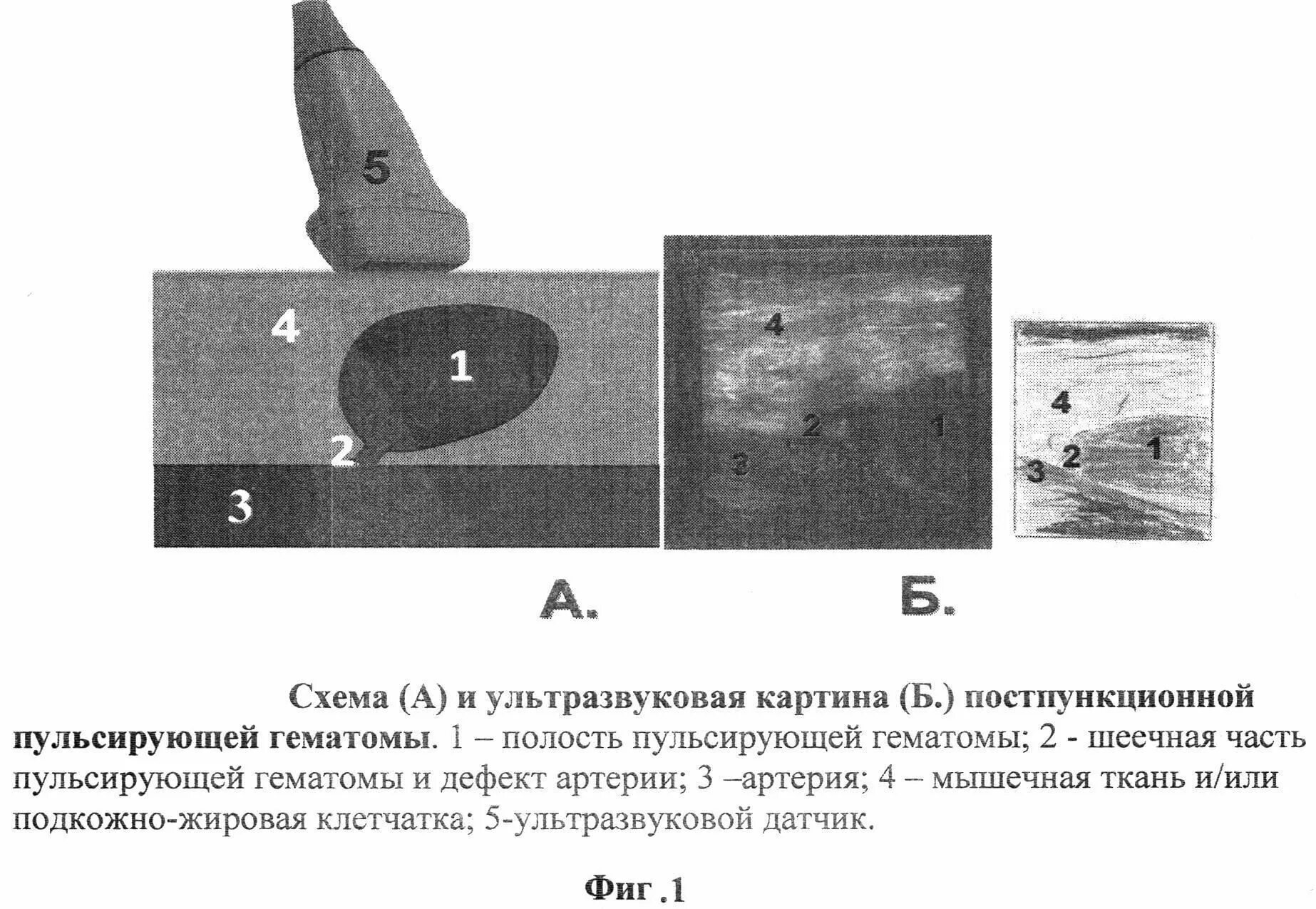 Пульсирующая гематома. Пульсирующая гематома узи. пульсирующая гематома бедренной артерии после стентирования. пульсирующая гематома и ложная аневризма. пульсирующая гематома общая хирургия.