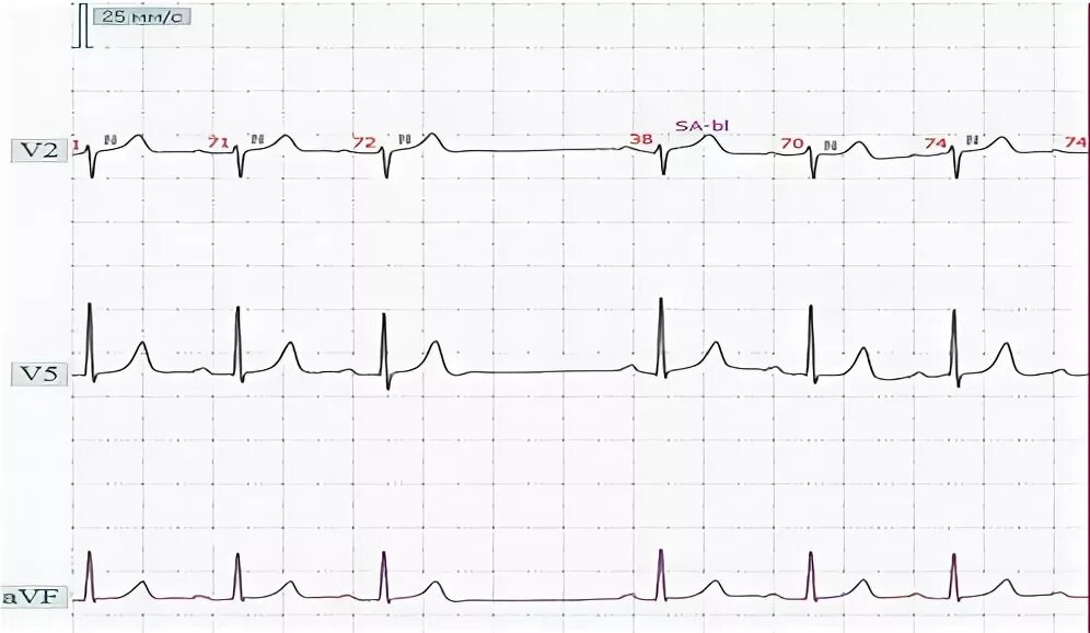 Са блокада 2 тип. Синоатриальная блокада 1 степени на ЭКГ. Синоатриальная блокада 2 степени на ЭКГ. ЭКГ синоатриальной блокады 1 степени. Синоатриальная блокада 2 степени типа Мобитц 1.