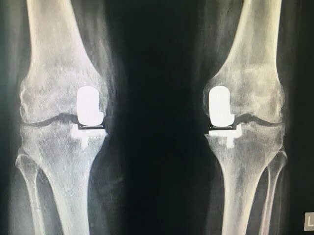 Одномыщелковое эндопротезирование коленного рентген. Эндопротез коленного сустава рентген. Тотальное эндопротезирование коленного сустава рентген. Спейсер коленного сустава рентген. Ростов замена коленного сустава