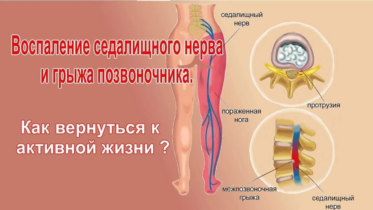 Болит нога после операции грыжи позвоночника. Воспаление воспаление седалищного нерва. Грыжа позвоночника защемление нерва. Седалищный нерв грыжа позвоночника. Грыжа защемила седалищный нерв.