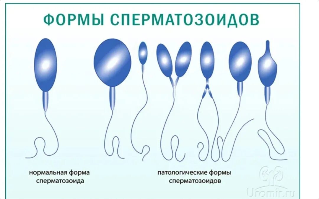 Тератозооспермия что это такое у мужчин причины. Тератозооспермия патология головки. Тератозооспермия. Тератозооспермия что это такое у мужчин причины. Тератозооспермия что это такое у мужчин причины.