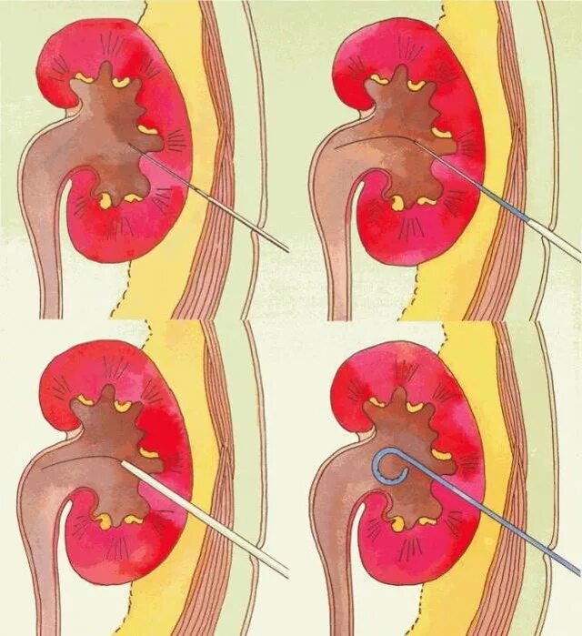Катетеризация мочеточника. Чрескожная пункционная нефростомия. Чрескожная (перкутанная) нефростомия. Чрескожная нефростомия почки.