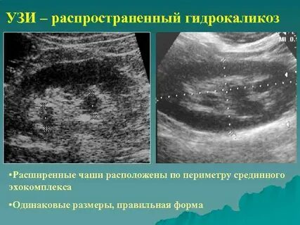 Гидрокаликоз почек