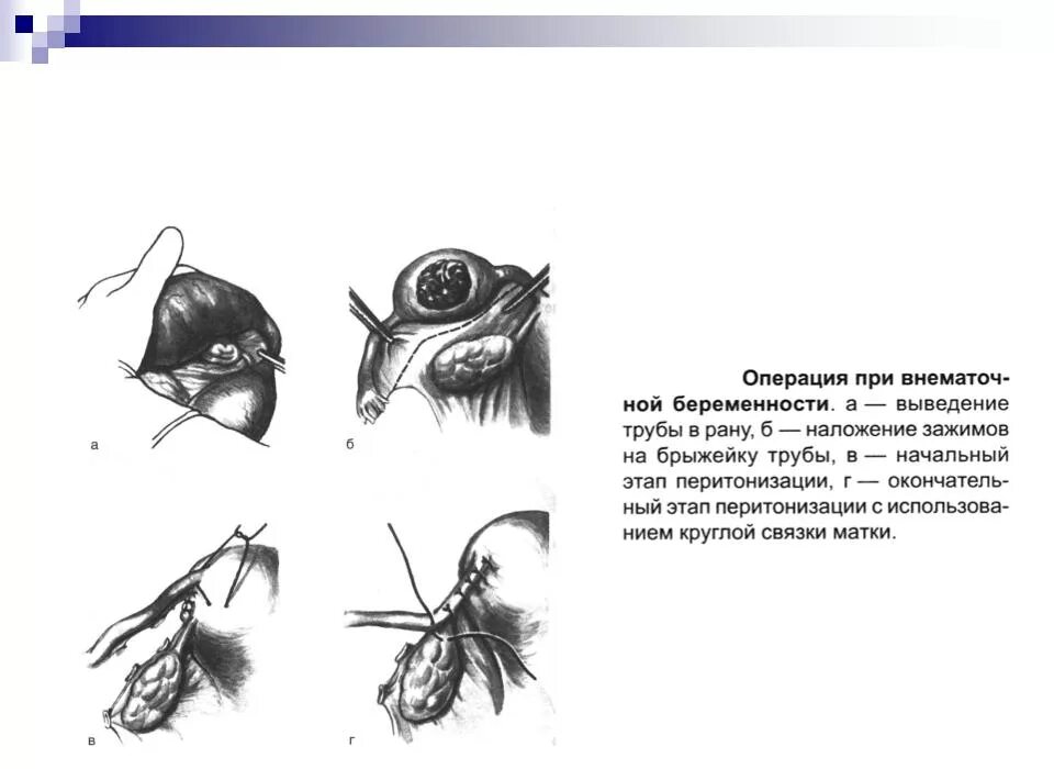 Операция при внематочной беременности. Внематочная Трубная беременность. Операция. Операция внематочной беременности лапароскопии. Этапы операции при трубной беременности. Удалили трубу можно ли забеременеть