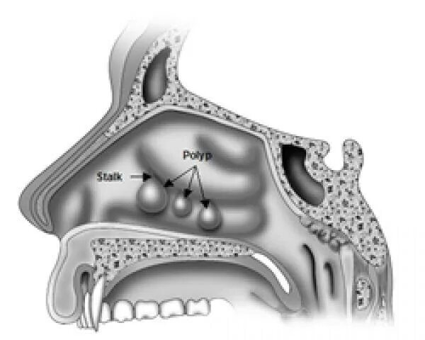полипоз околоносовых пазух