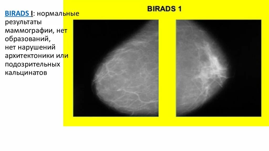 Маммография молочных желез bi rads 4. Классификация bi-rads молочных желез. Классификация bi-rads молочных желез в маммографии. Маммография молочных желез bi rads 1. Что означает категория bi rads