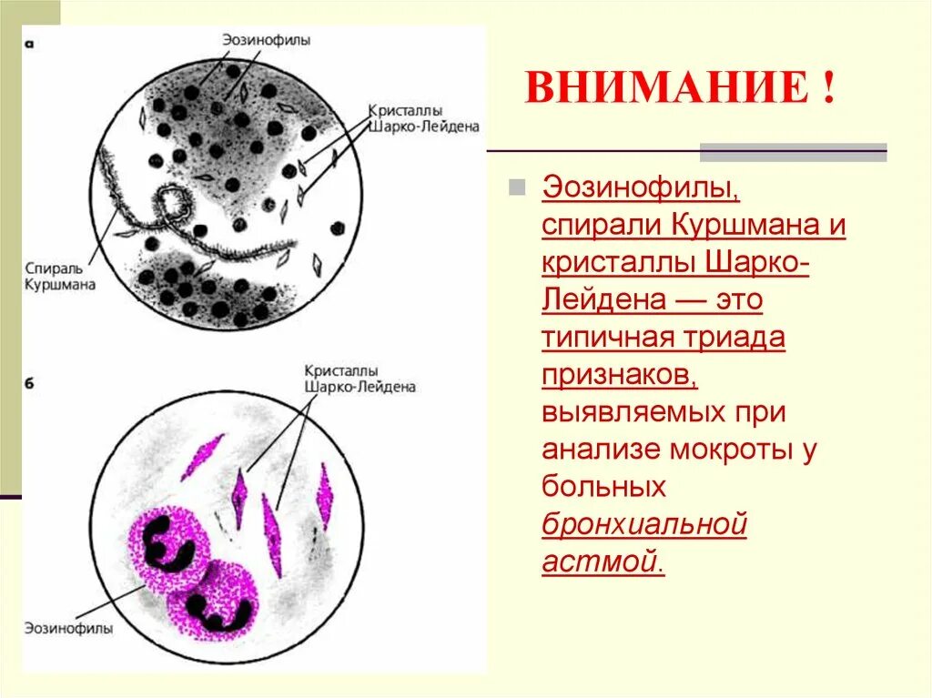 Шарко лейдена в кале. Спирали Куршмана, Кристаллы Шарко-Лейдена, эозинофилы. Эозинофилия спирали Куршмана Кристаллы Шарко-Лейдена. Исследование мокроты спирали Куршмана. Спиральные элементы Куршмана.