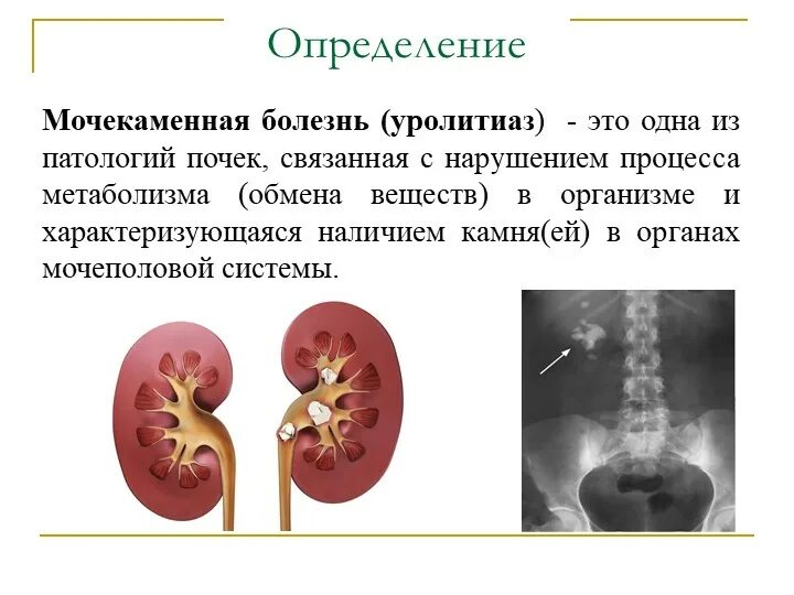 Причины почечных заболеваний. Мочекаменная болезнь (уролитиаз). Основные клинические проявления мочекаменной болезни. Блок почки при мочекаменной болезни. Мочекаменная болезнь классификация клиника.