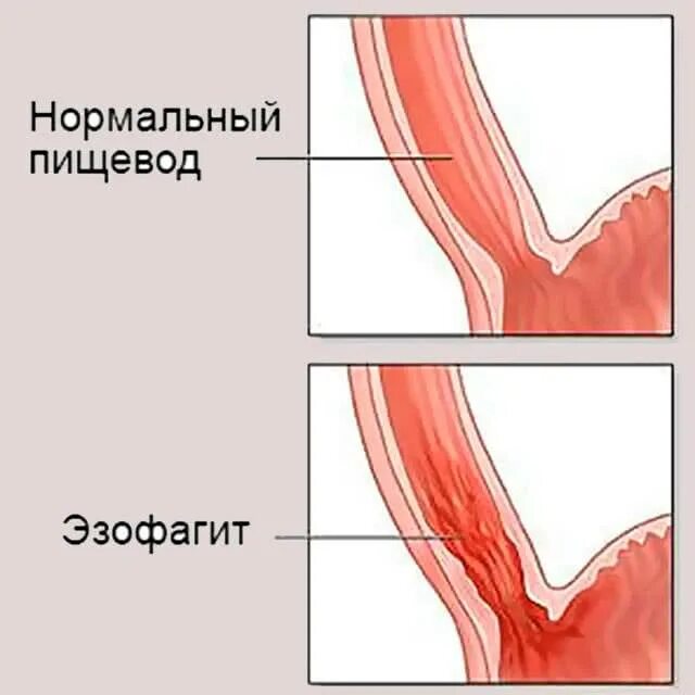 Ком в пищеводе причины. Эрозивный рефлюкс-эзофагит. Дистальный катаральный рефлюкс-эзофагит. Острый катаральный эзофагит. Рефлюксэзофагит дисталтный каторальный.