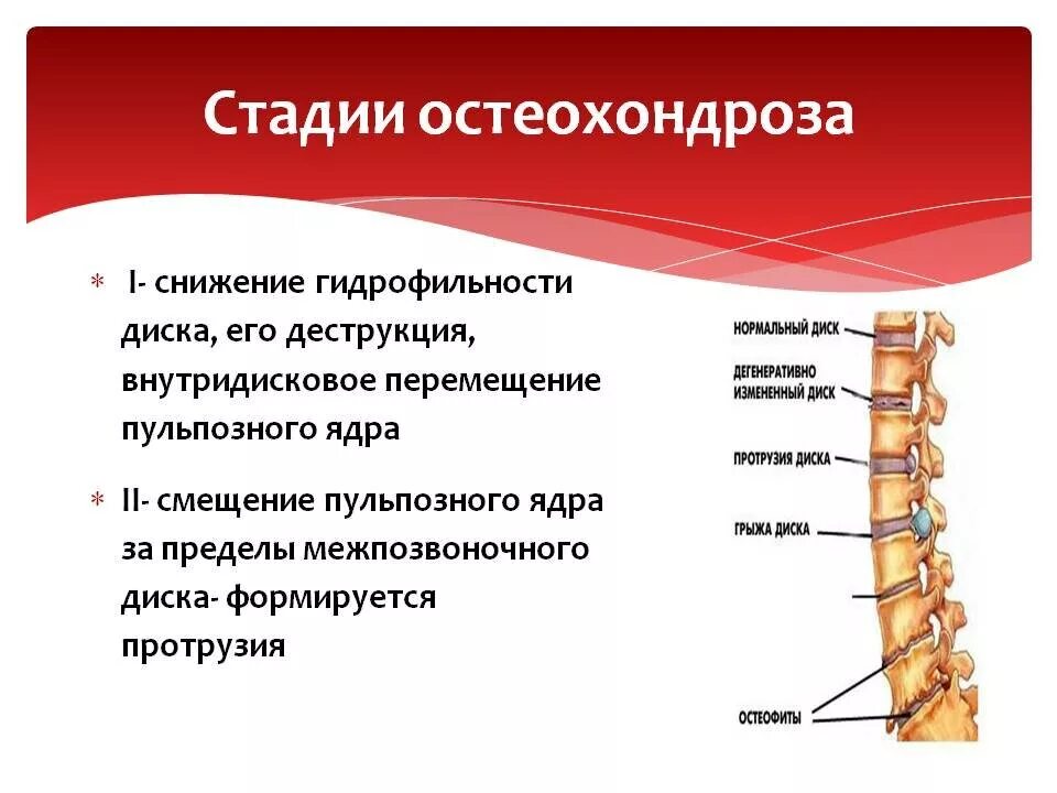 Можно ли вылечить шейный позвоночник. Остеохондроз грудного отдела позвоночников 1 2-3 степени. остеохондроз грудного отдела позвоночника 1 степени. этапы развития остеохондроза позвоночника. остеохондроз 2 степени межпозвоночных дисков грудного отдела.