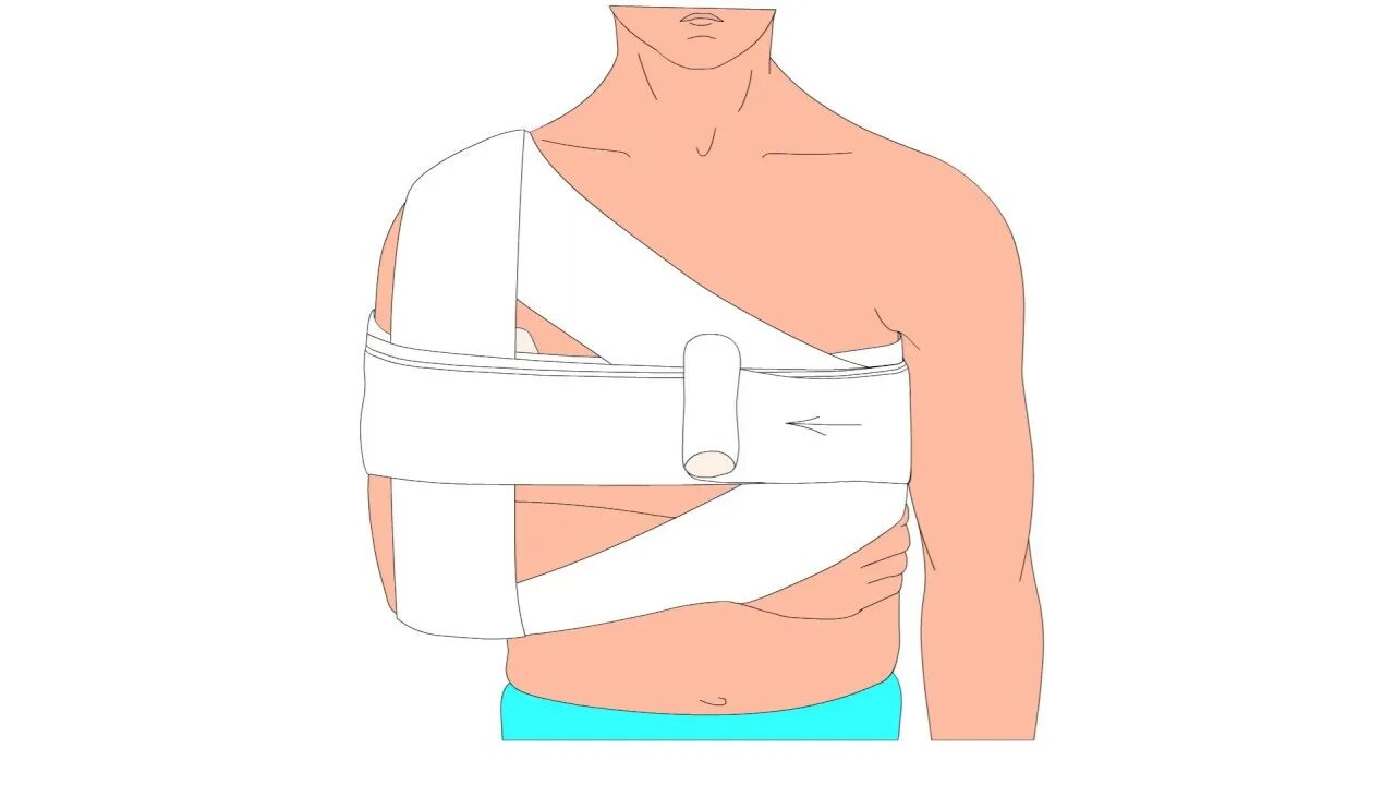 Дезо видео. Повязка Дезо гипсовая техника. Бинтовая повязка Дезо. Перелом ключицы повязка Дезо. Повязка Дезо при переломе ключицы.