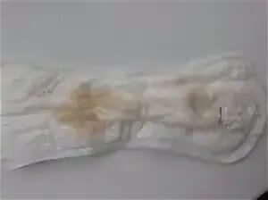 Опасные выделения на раннем сроке беременности