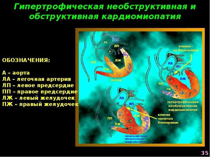 Гипертрофическая обструктивная кардиомиопатия. Формы гипертрофической кардиомиопатии. Обструктивная форма гипертрофической кардиомиопатии. Патогенез обструктивной гипертрофической кардиомиопатии. Для гипертрофической обструктивной кардиомиопатии характерно.