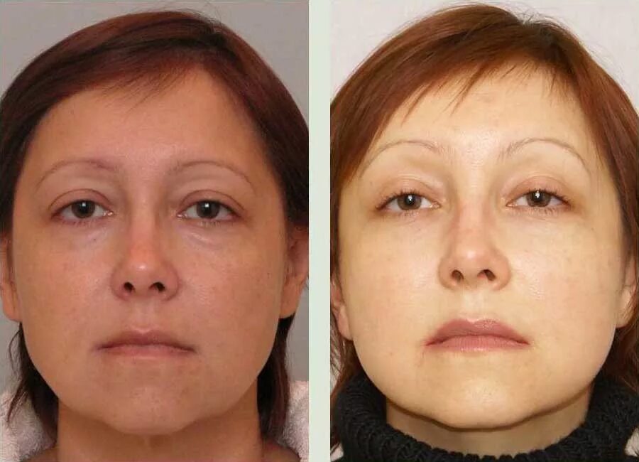 Эндоскопическая подтяжка лба. Эндоскопическая подтяжка лба и бровей. Эндоскопическая подтяжка бровей. Подтяжка лба. Эндоскопическая подтяжка бровей.