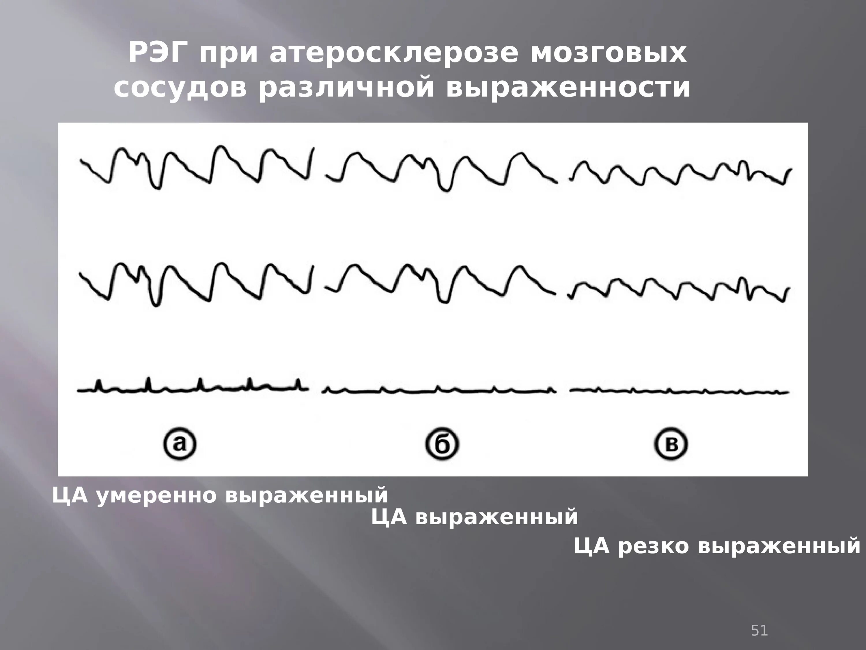 Умеренно выраженная резко выраженная
