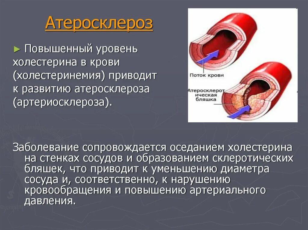 Атеросклероз сосудов ишемическая болезнь. Причины заболевания атеросклероза. Атеросклеротические изменения сосудов. Атеросклеротические изменения в артерии. Сужение сосудов симптомы причины