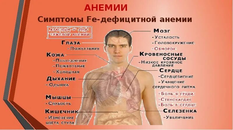 Анемия больные. Презентация на тему анемия. Анемия симптомы внешние.