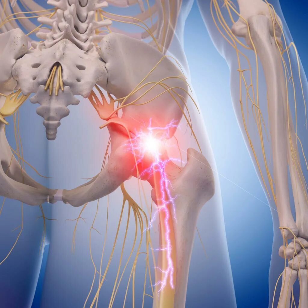 Сильно болит седалищный нерв. Тазобедренный сустав седалищный нерв. Защемило седалищный нерв. Защемление седалищного нерва.