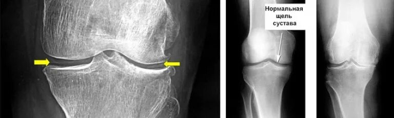 Здоровый коленный сустав рентгеновский снимок. Коксартроз тазобедренного 3ст. Гонартроз коленного рентген. Синовит коленного сустава рентген. Суставная щель не сужена.