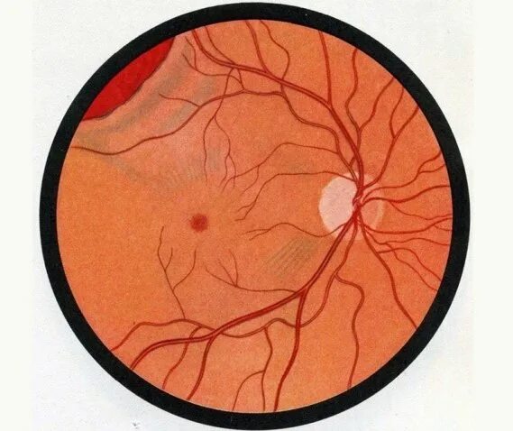 Пузыревидная отслойка сетчатки. Отслоение сетчатки - ретинопатия.. Транссудативная отслойка сетчатки. Неопластическая отслойка сетчатки. Повреждение сетчатки