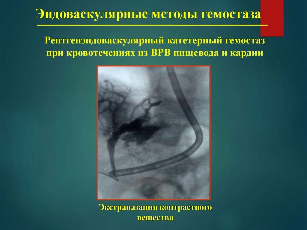 Что такое экстравазация. Эндоваскулярным методом. эндоваскулярные методы гемостаза. экстравазация контраста.