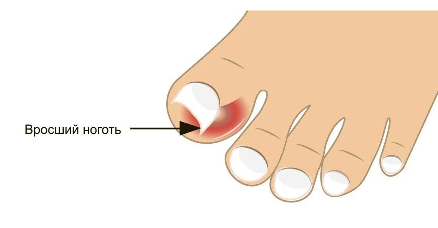 Впился ноготь что делать. Врошийся ноготь на ноге.
