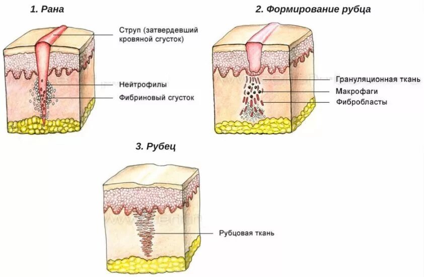 Этапы заживления ран. Фазы заживления РАН схема. Грануляционная ткань в ране.