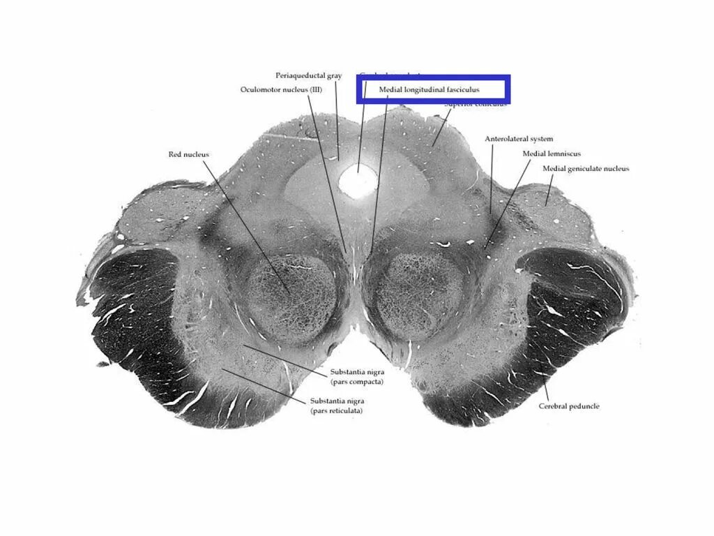 Средний мозг красное ядро черная субстанция. Черное вещество среднего мозга. Красное ядро среднего мозга мрт. Средний мозг СИЛЬВИЕВ водопровод. Серый мозг латынь