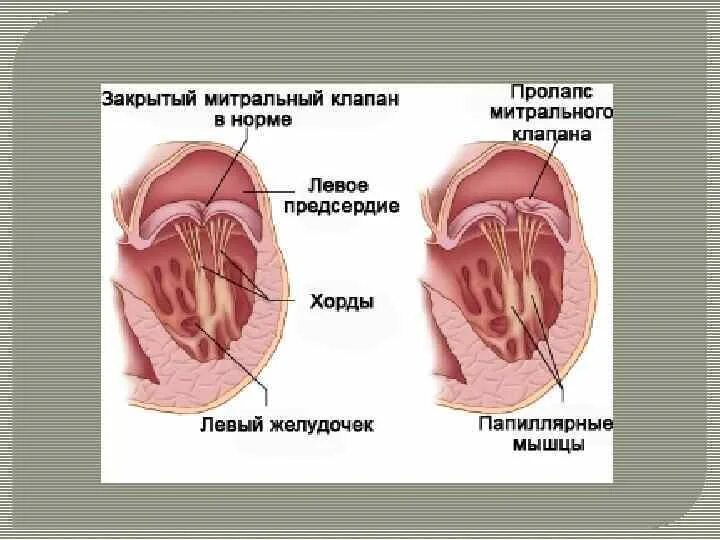 Что такое пролапс митрального клапана. Пролапс передней стенки митрального клапана. Компенсированный пролапс митрального клапана.