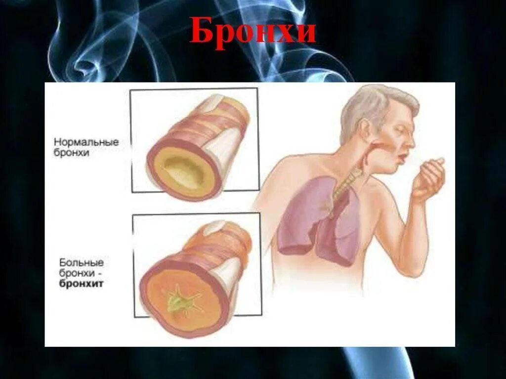Мокрота в бронхах. Мокрота в бронхах