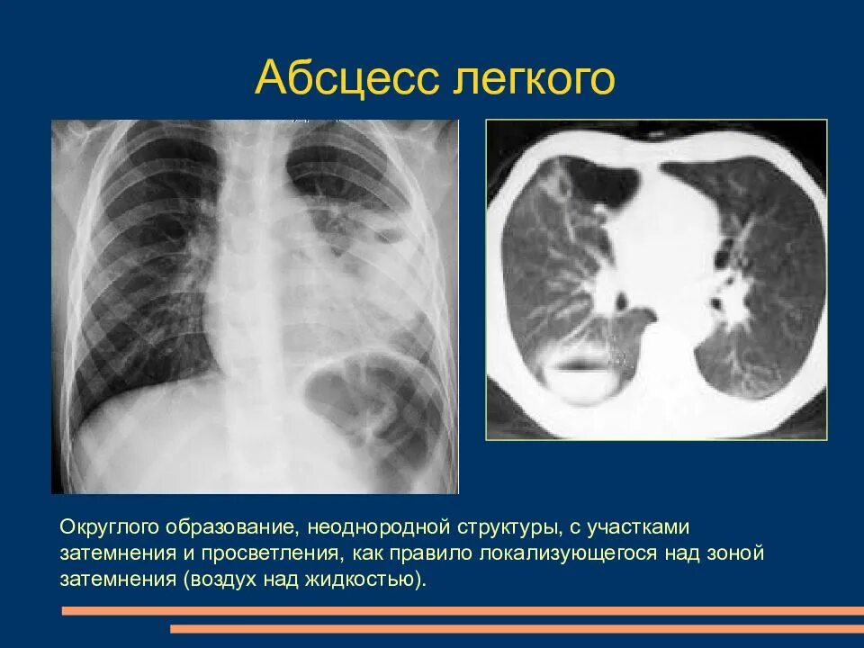 Округлое затемнение. Негомогенное затемнение легочной ткани. Участок затемнения в легочной ткани. Гомогенное затемнение легких на рентгене. Гомогенное затемнение легких что это.