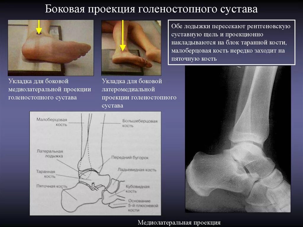 Описание голеностопного сустава. Голеностопный сустав в боковой проекции. Таранная кость голеностопного сустава. Проекции голеностопного сустава рентген. Рентген голеностопного сустава в боковой проекции.