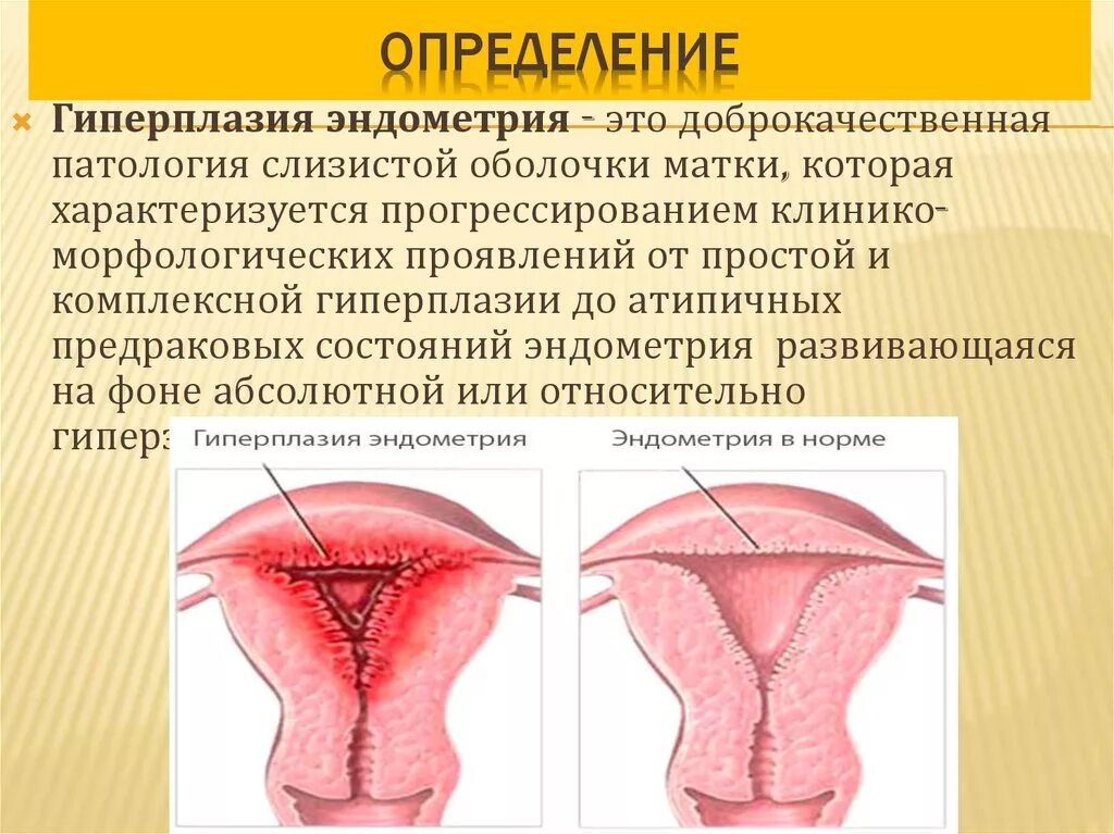 Гиперплазия эндометрия ppt. Гиперплазия эндометрия матки что это. Очаговая гиперплазия эндометрия. Ретровирусная гиперплазия.