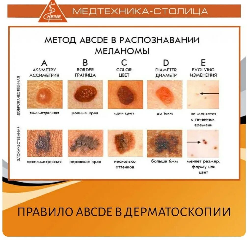 Меланома кожи дифференциальный диагноз. Меланоцитарные опухоли кожи классификация. Новообразование меланома стадии. Родинка читать по главам